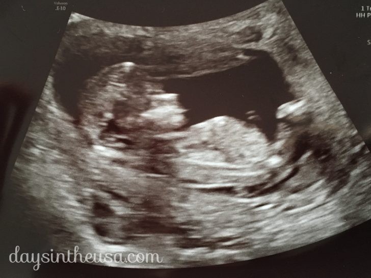 アメリカで出産 第2回 妊婦健診レポート 胎児ドック Nt検査 Days In The U S A